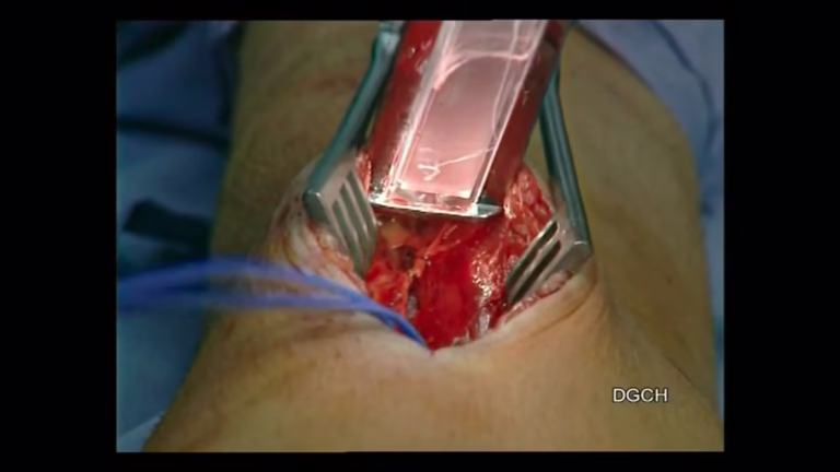 Minimal-invasive Entnahme von Bypass-Grafts (Art. radialis)